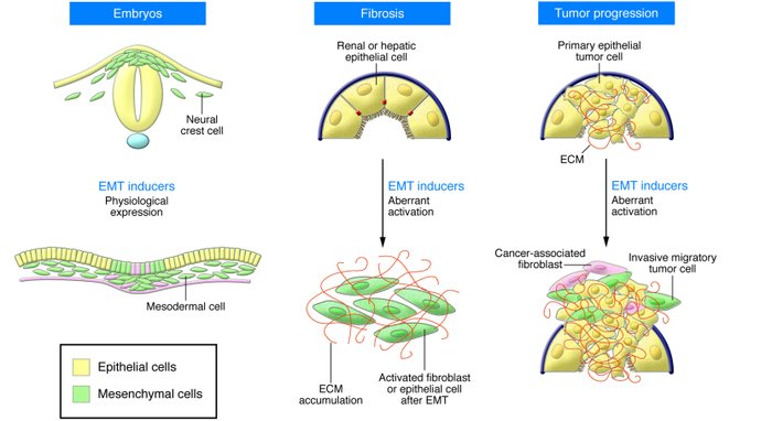 epithelial mesenchymal transition cancer