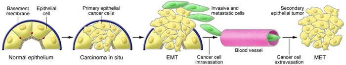 Contribution of EMT to cancer progression.
Progression from normal epith...