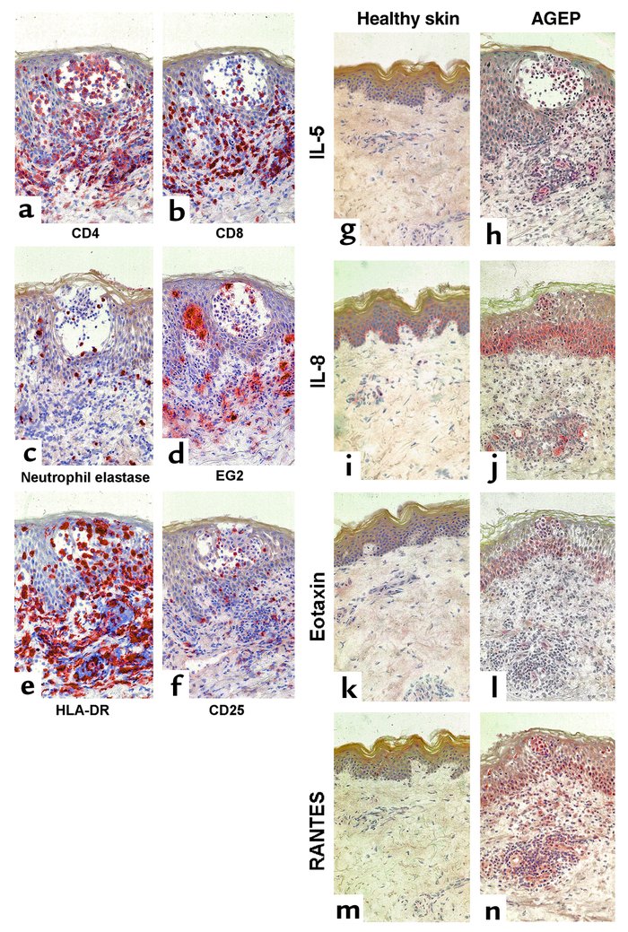 Immunohistochemical analysis of skin biopsy obtained from positive epicu...