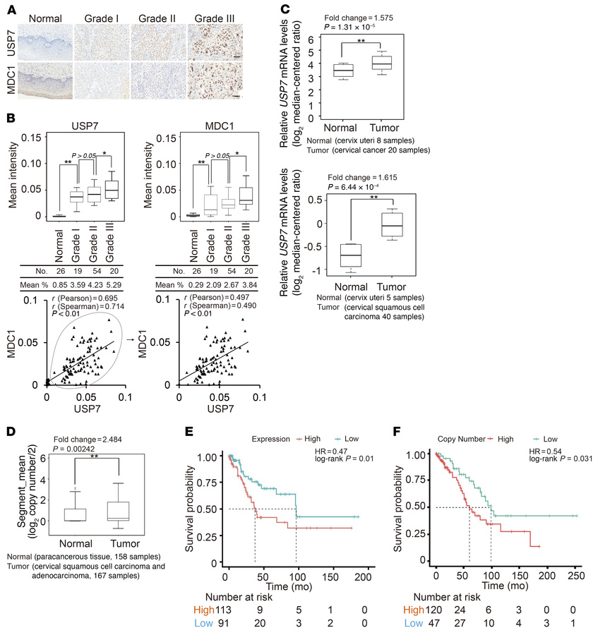 USP7 is implicated in cervical carcinogenesis and patient survival.
(A) ...