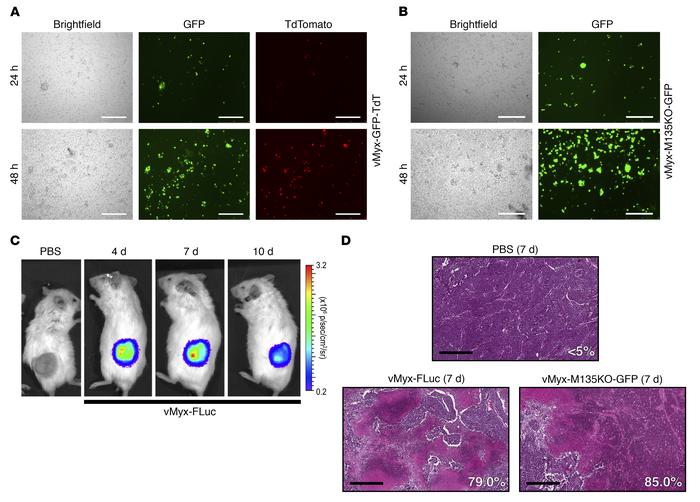 Primary human SCLC specimen is permissive to MYXV, and a direct intratum...