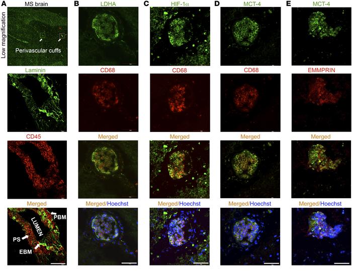 Infiltrating macrophages in active MS cuffs express LDHA and other glyco...