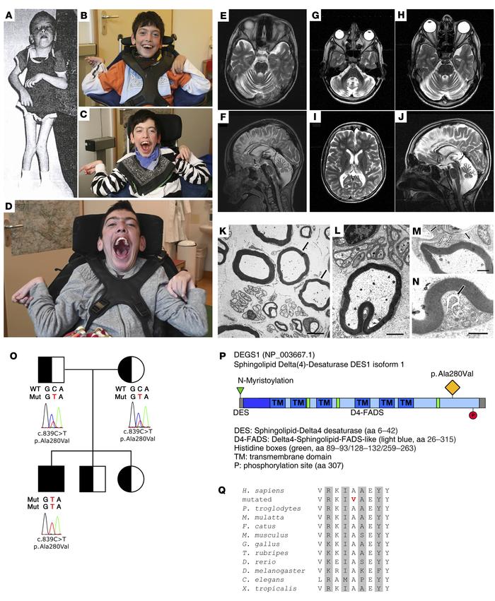 Clinical phenotype and genetics of the DEGS1 disorder.
Clinical phenotyp...