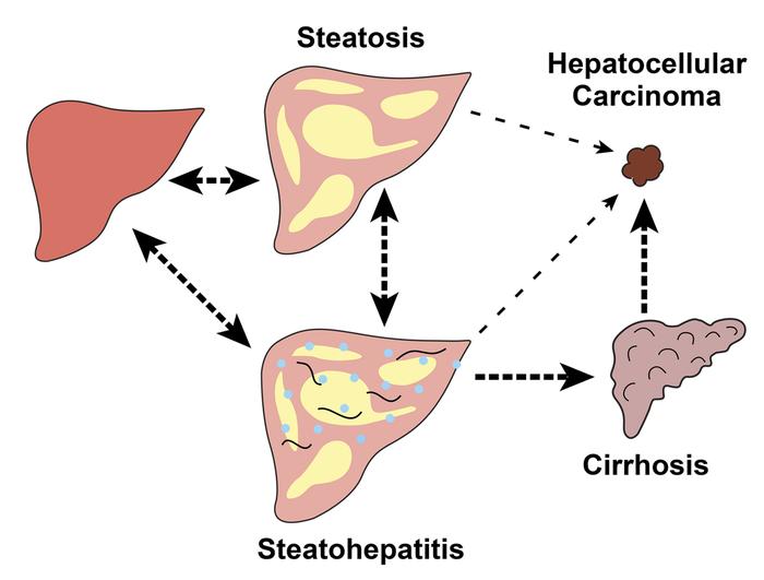 Fatty liver disease (FLD): a continuum of related disorders.
Both alcoho...