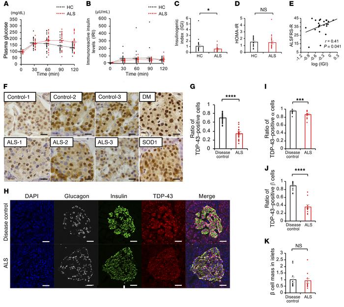 Decreased insulin secretion and loss of pancreatic TDP-43 in patients wi...