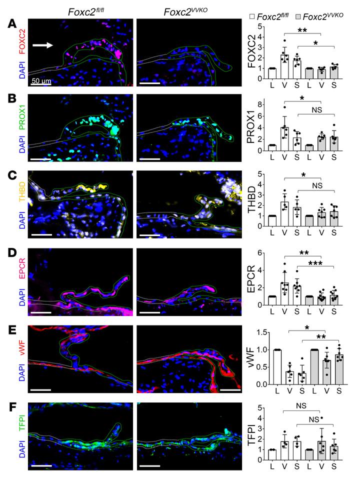 Loss of FOXC2 results in loss of THBD and EPCR and gain of vWF in periva...