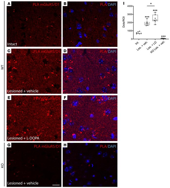 Endogenous D1-mGlu5 clusters are increased in the DA-denervated striatum...