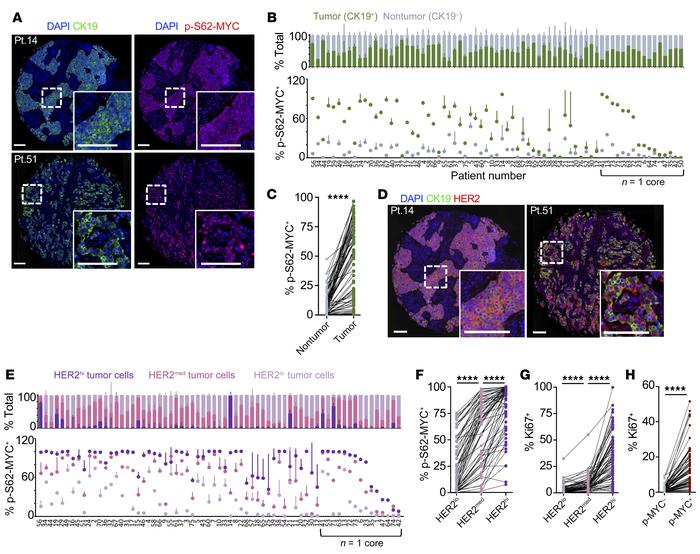 MYC phosphorylation is elevated in HER2+ patient tumors and correlated w...