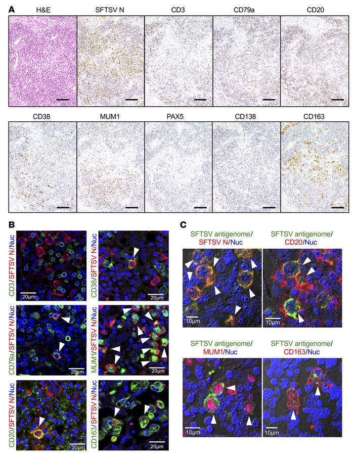 SFTSV-antigen+ cells in the lymph nodes of individuals who died because ...