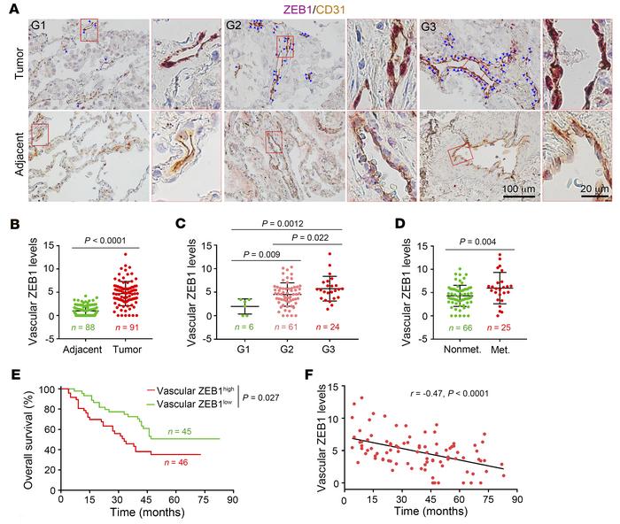 Vascular ZEB1 expression correlates negatively with survival rates in lu...