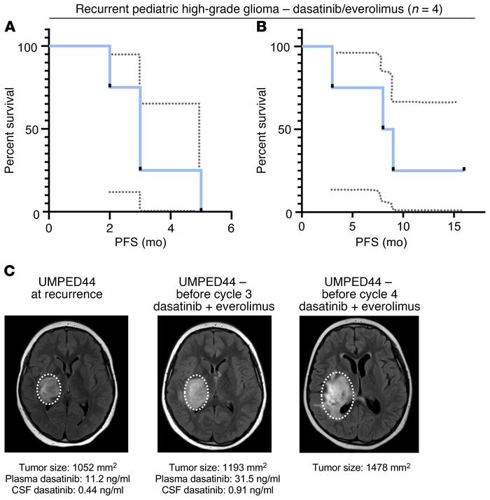 Patient survival curves and treatment of UMPED44 with relapsed PDGFRA-am...
