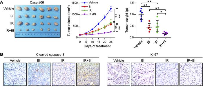BI-D1870 improves the therapeutic efficacy of radiotherapy in ESCC PDXs....