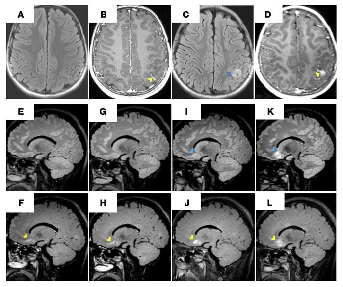 CTLA4h-associated neuroinflammation often starts in the leptomeninges.
L...