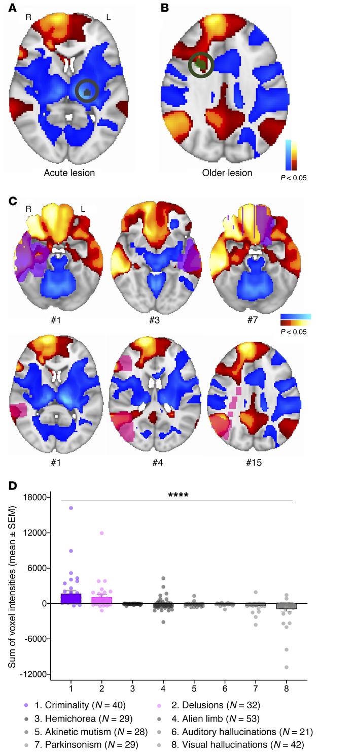 Intersection of our mania lesion network with other lesion locations.
(A...