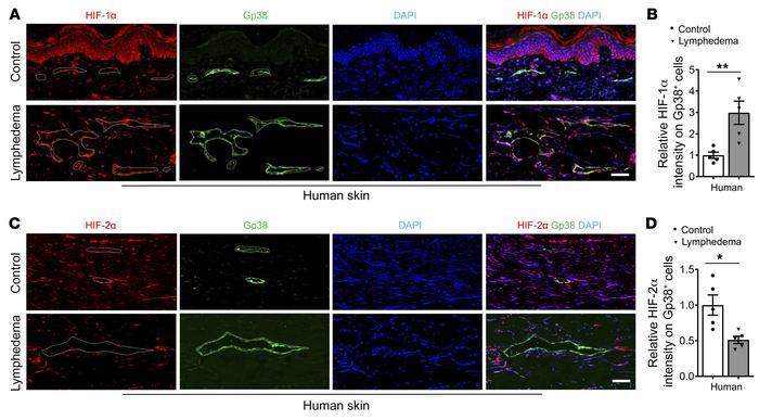 Increased HIF-1α but decreased HIF-2α expression in LECs of human lymphe...