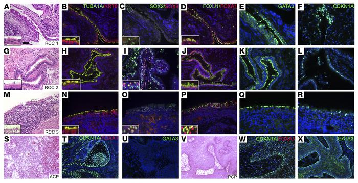 hRCCs express FOXA1.
(A–R) Classification of hRCC samples (n = 16) was c...