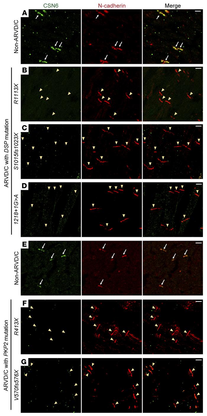 Human desmosomal mutations associated with ARVD/C affect CSN6 localizati...