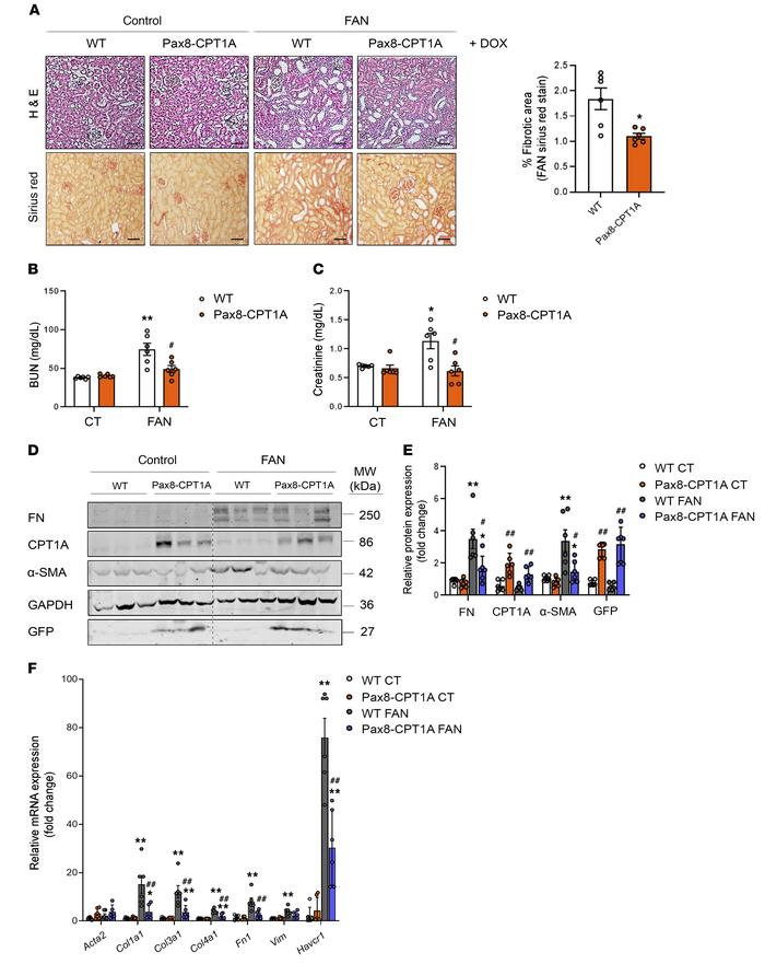 CPT1A overexpression prevents FAN-associated kidney function deteriorati...