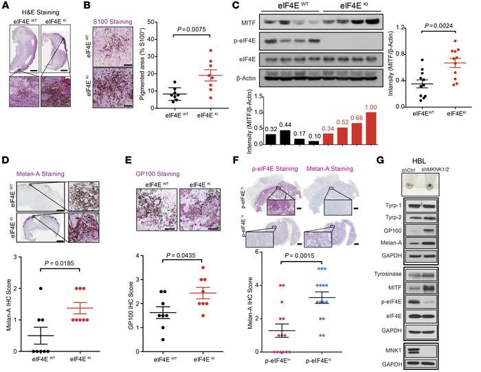 Phospho-eIF4E–deficient murine and human melanomas are more differentiat...