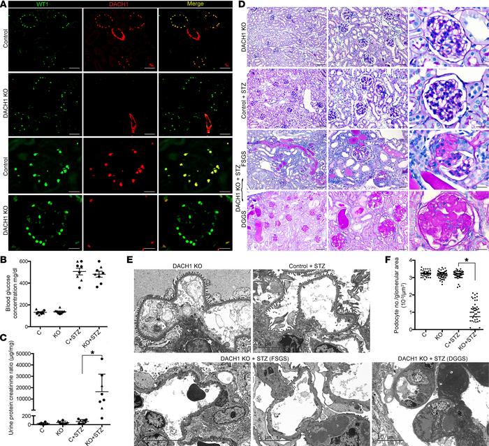 Podocyte-specific Dach1 KO mice, after onset of type I DM, exhibit sever...