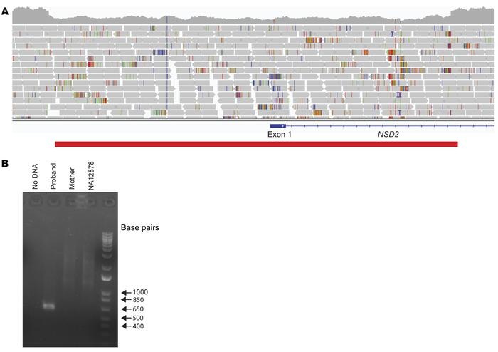 Case 4 — NSD2-associated ID syndrome.
(A) A 3.9 kb deletion (red bar) in...