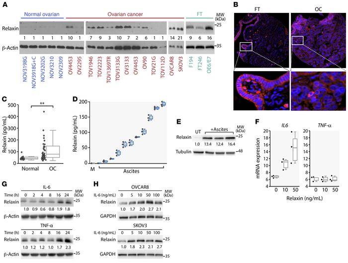 Analysis of relaxin expression in patient-derived OC tumors, serum, and ...