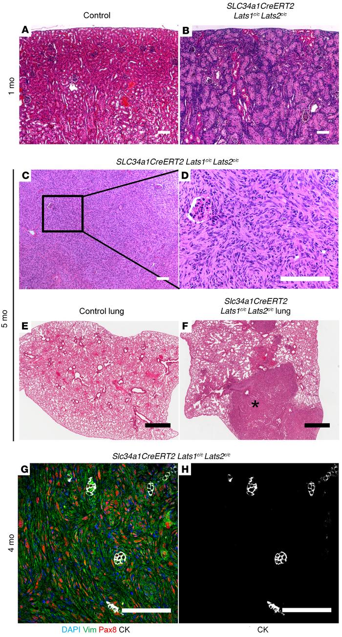 Ablation of Lats in the proximal tubules leads to metastatic sRCC.
(A–F)...
