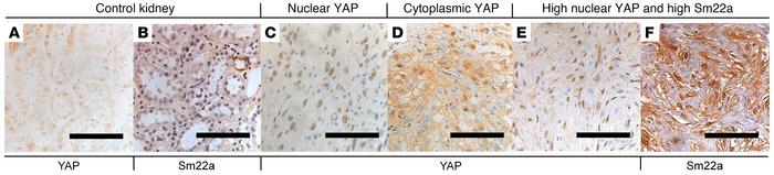 Human RCC TMAs reveal heterogeneity in YAP and YAP target expression.
Ex...