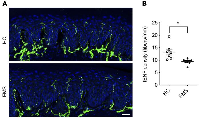 FMS IgG transfer decreases intraepidermal nerve fiber density.
Intraepid...