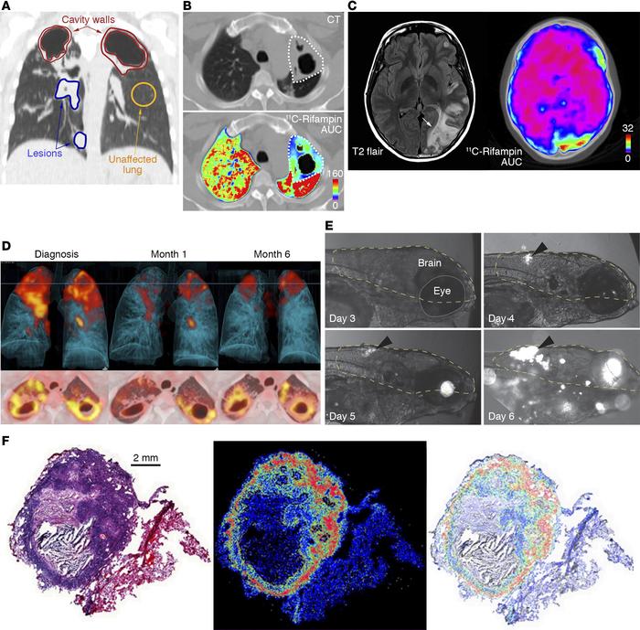 Spatial and temporal heterogeneity in TB lesions.
(A) Coronal CT section...