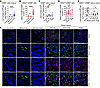 ARG1-expressing myeloid cells accumulate in human breast cancer tissue.