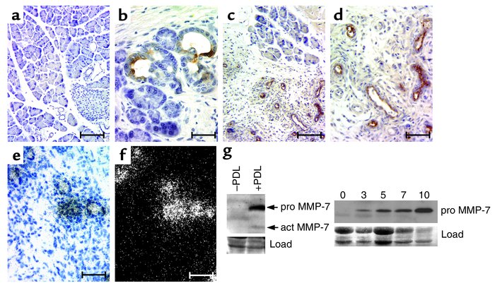 MMP-7 expression in metaplastic ducts of the mouse pancreas. MMP-7 immun...