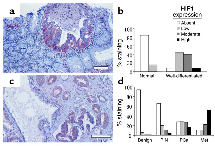 Immunohistochemical analysis of colon and prostate tumors. In separate e...