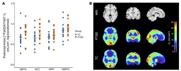Prefrontal-limbic 11β-HSD1 availability is higher in individuals with PT...