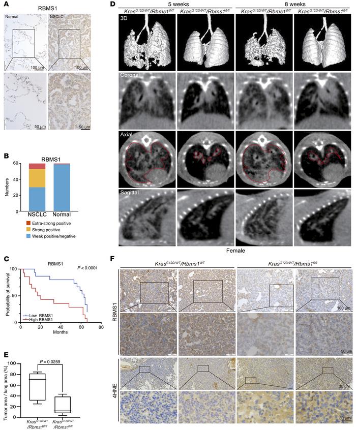 RBMS1 is associated with lung cancer progression and prognosis in humans...