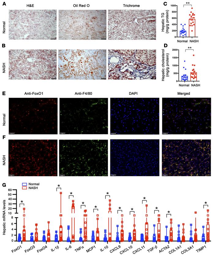 FOXO1 is deregulated in hepatic macrophages of humans with NASH.
Liver b...