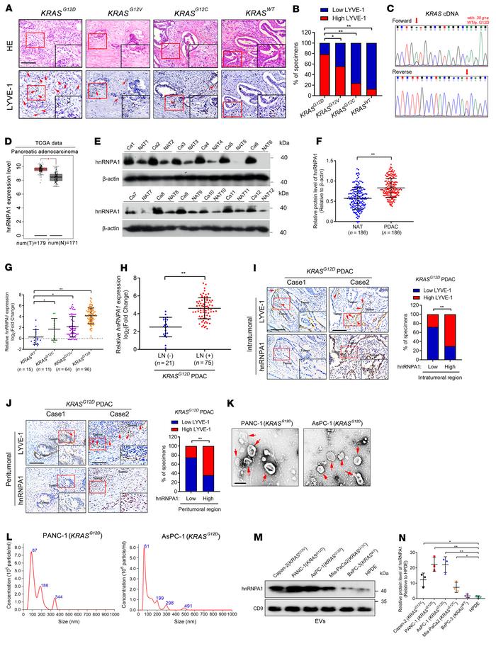 HnRNPA1 correlates with LN metastasis of KRASG12D PDAC.
(A and B) Repres...