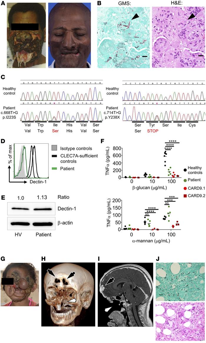 A Dectin-1–deficient patient with severe Corynespora cassiicola phaeohyp...