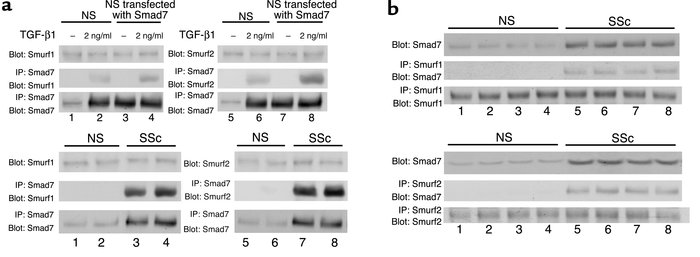 Smad7 can interact with Smurfs in scleroderma fibroblasts. (a) Whole-cel...