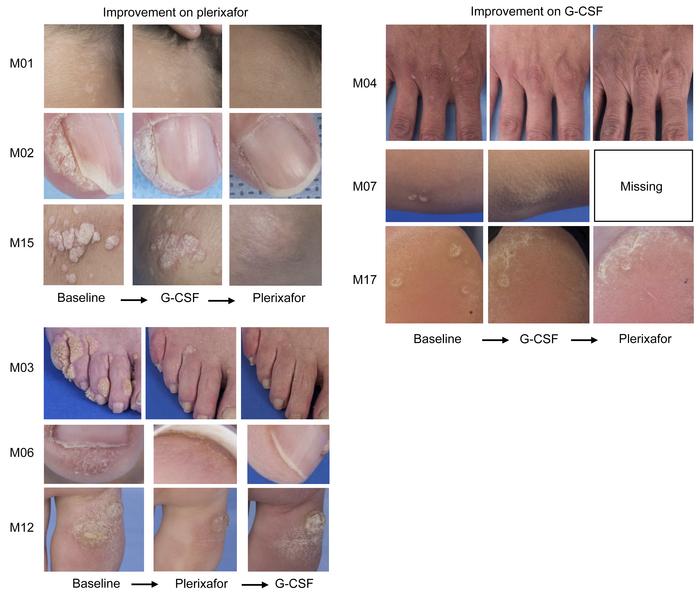 Plerixafor and G-CSF effects on wart burden in patients with WHIM.
Repre...