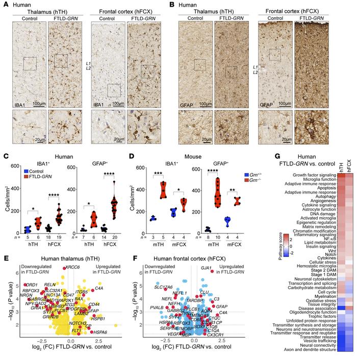 Glial pathology in thalamus and frontal cortex of patients with FTLD-GRN...