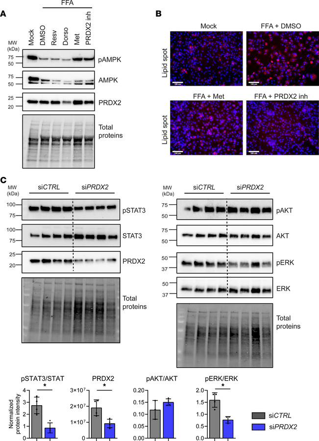 Targeting PRDX2 improves lipid metabolism and suppresses procarcinogenic...