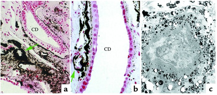 Accumulation of interstitial crystal deposits. In (a) and (b), extensive...