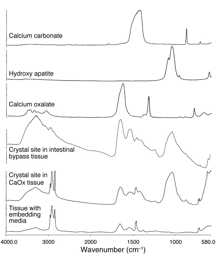 μ-FTIR spectra of crystal deposits in CaOx and intestinal-bypass patient...