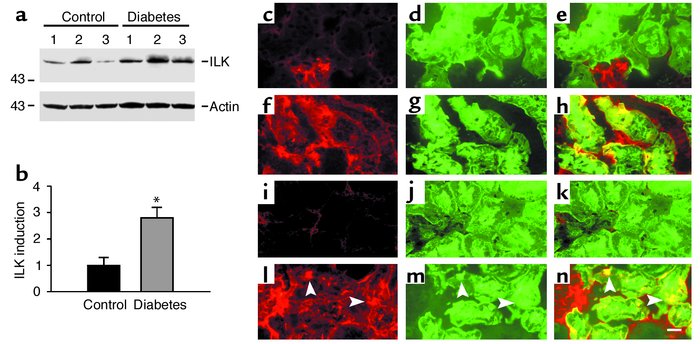 Induction of ILK expression in renal epithelia in diabetic nephropathy i...