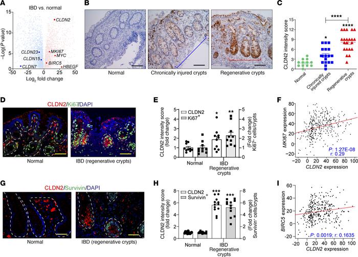In patients with IBD, colitis-associated CLDN2 upregulation is concentra...