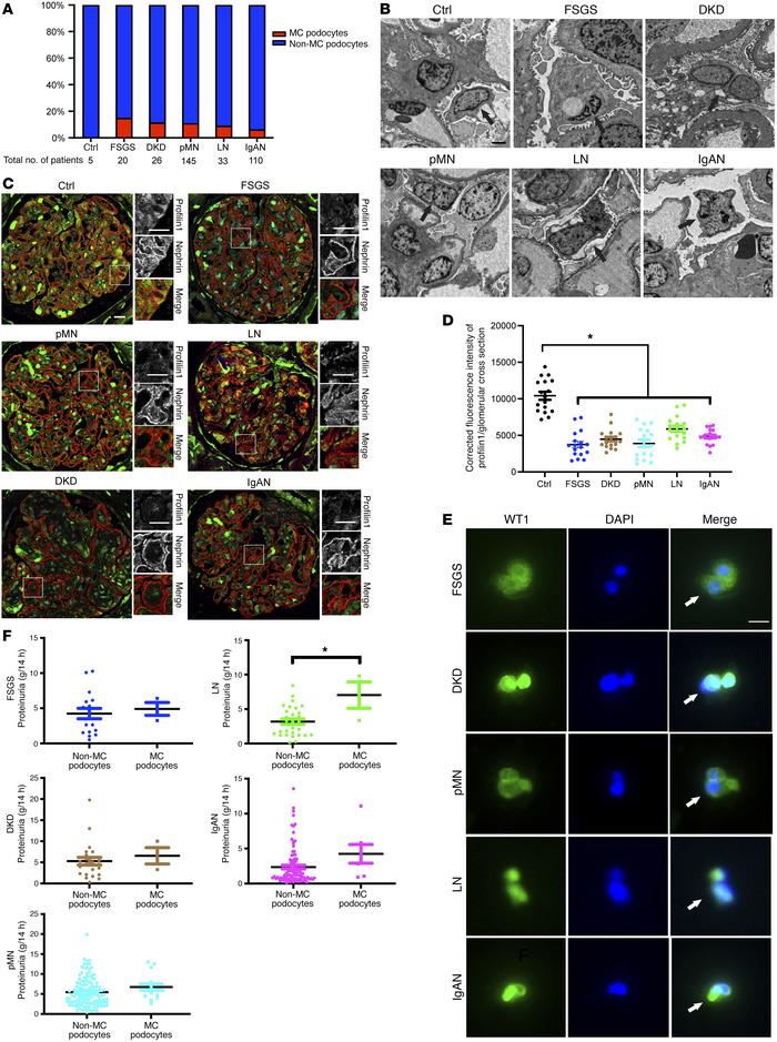 Patients with proteinuric kidney disease demonstrate reduced podocyte PF...