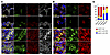 Accumulation and localization of SP-C(I73T) and EMC4 in patients with SFTPC