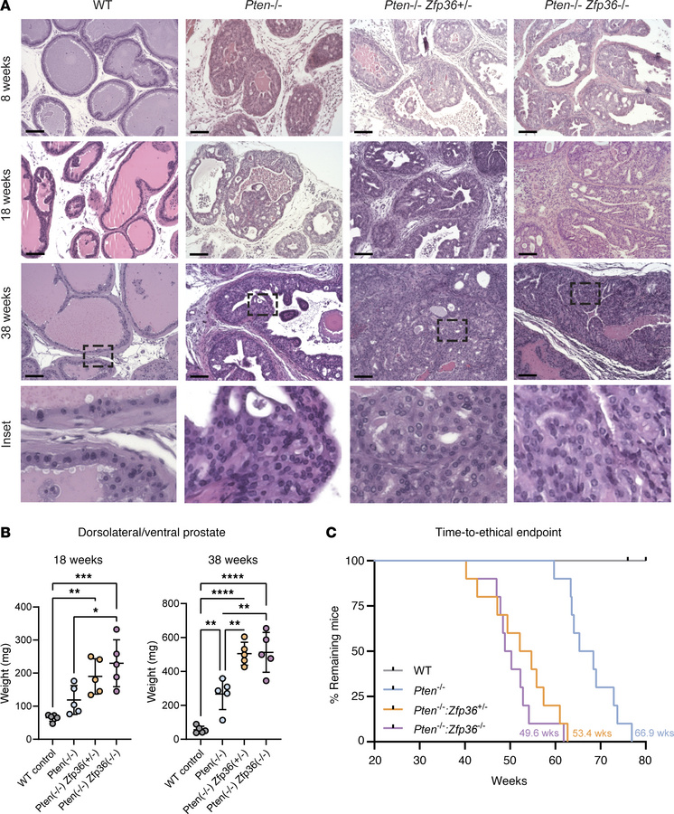 
Zfp36 loss accelerates progression of prostate cancer in Pten-null muri...