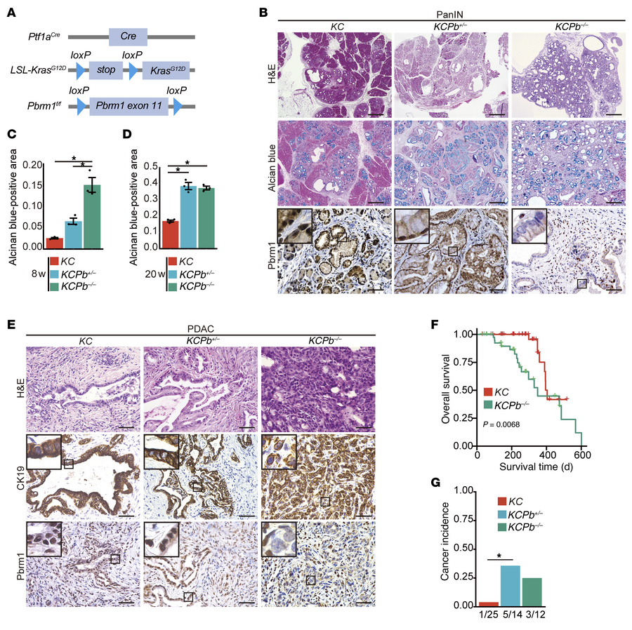 Pancreatic PBRM1 deletion accelerates the formation of precancerous lesi...